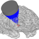 Graphical representation of the targeted brain stimulation with ultrasound.